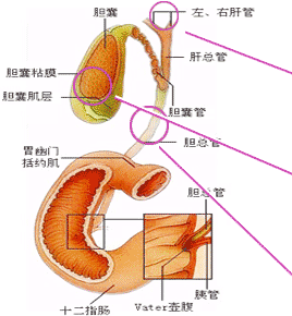 膽結石