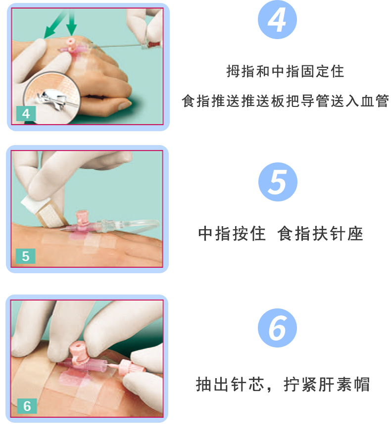 沃素安24G動靜脈留置針